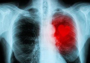 Early Menopause: A Tell-Tale Sign for Heart Disease and Stroke