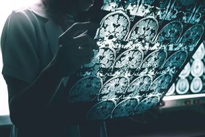 Metabolic Changes a Potential Trigger for Alzheimer’s Disease
