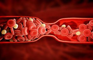 Testosterone Replacement Therapy: A Potential Cause of Blood Clots 1