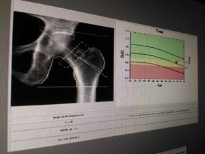 Melatonin to Improve Bone Density 1