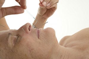 Acupuncture for Hot Flashes 1
