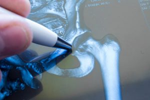 The Role of Dietary Patterns on Fractures, Post Menopause 1