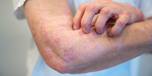 Scientists Uncover Why Psoriasis Can Lead to Joint Disease