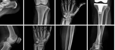 New Hope for Bones and Joints: Researchers Develop Regenerative Therapies